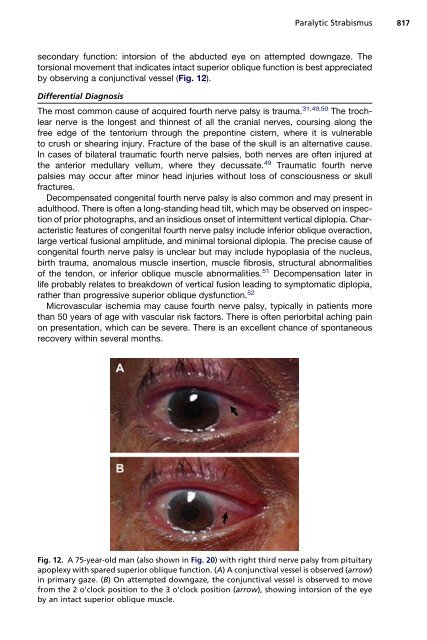 Paralytic Strabismus: Third, Fourth, and Sixth Nerve Palsy