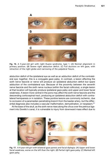 Paralytic Strabismus: Third, Fourth, and Sixth Nerve Palsy