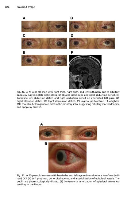 Paralytic Strabismus: Third, Fourth, and Sixth Nerve Palsy