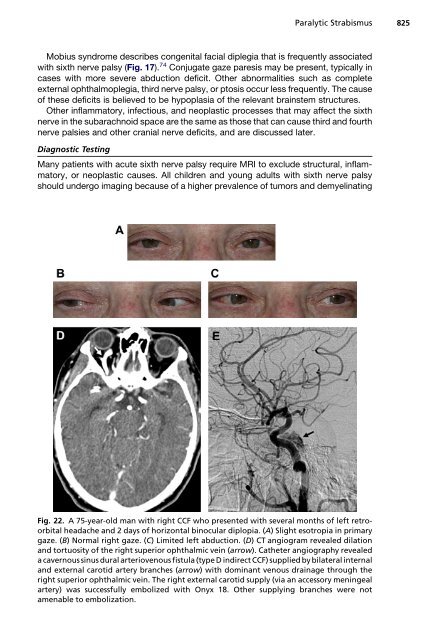 Paralytic Strabismus: Third, Fourth, and Sixth Nerve Palsy