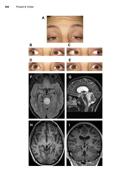 Paralytic Strabismus: Third, Fourth, and Sixth Nerve Palsy