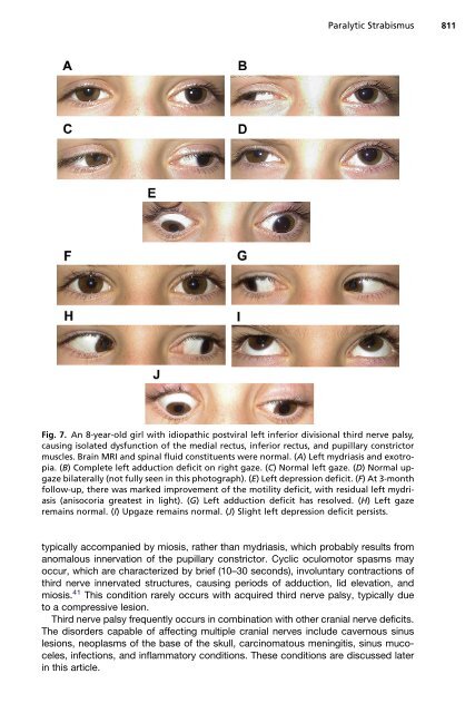 Paralytic Strabismus: Third, Fourth, and Sixth Nerve Palsy