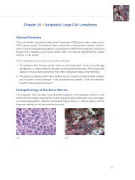 Chapter 24 Anaplastic Large-Cell Lymphoma - Dako