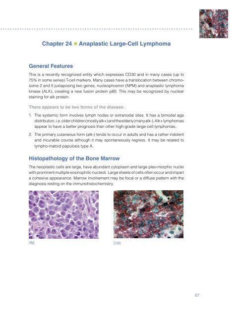 Chapter 24 Anaplastic Large-Cell Lymphoma - Dako