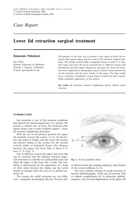 Case Report Lower lid retraction surgical treatment