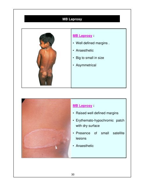 Leprosy Training Module for Medical Officers