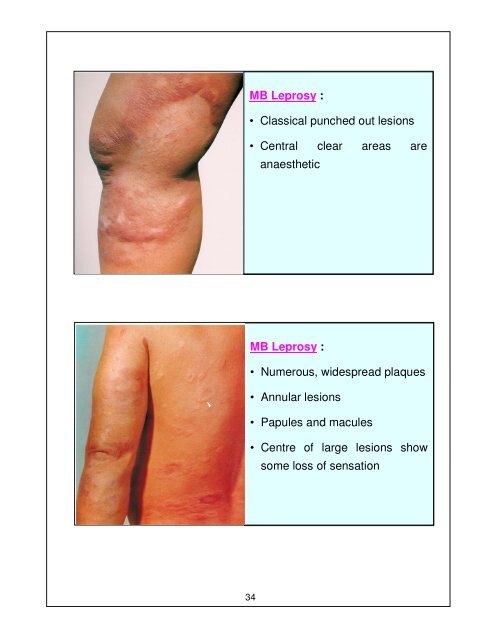 Leprosy Training Module for Medical Officers