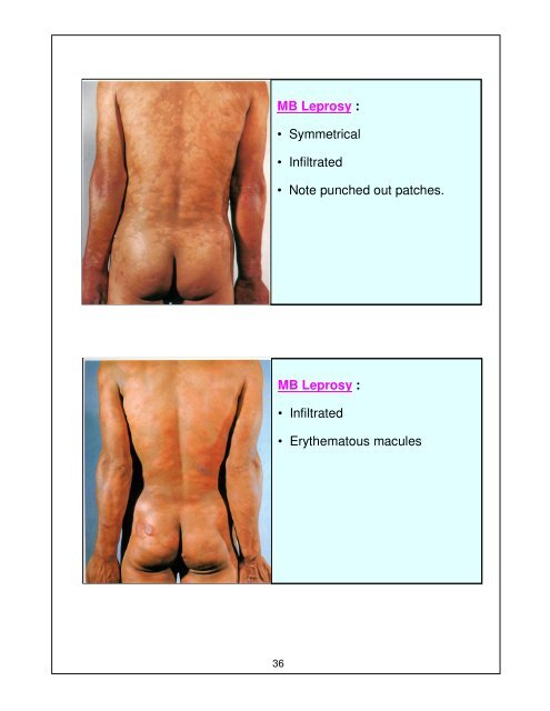 Leprosy Training Module for Medical Officers