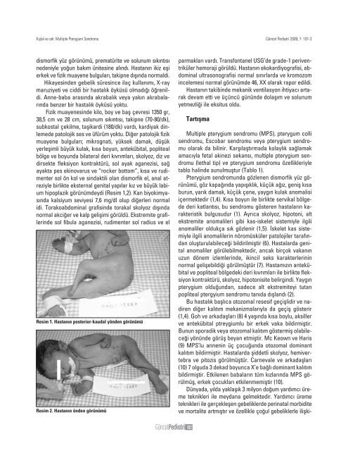 Multiple Pterygium Sendromu - Güncel Pediatri Dergisi