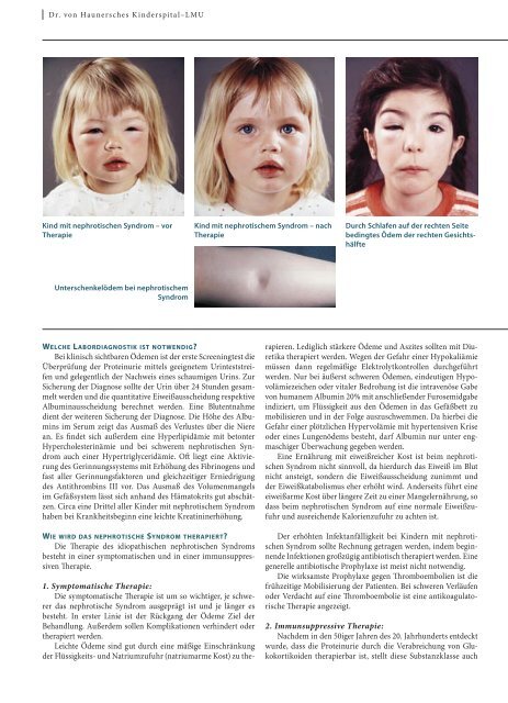 Nephrotisches Syndrom im Kindesalter - Hauner Journal