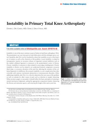 Instability in Primary Total Knee Arthroplasty - Healio