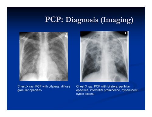 Clinical Manifestations & Opportunistic Infections - Health[e ...