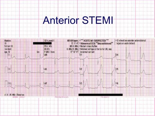 Anterior STEMI