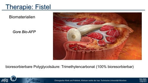 Lower GI - Chirurgie