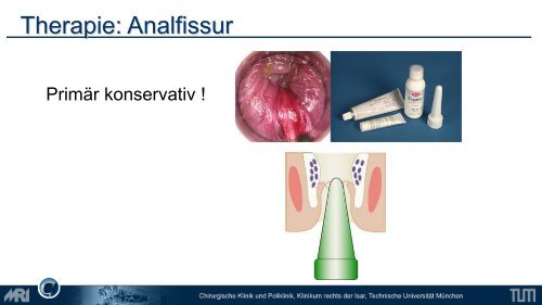 Lower GI - Chirurgie