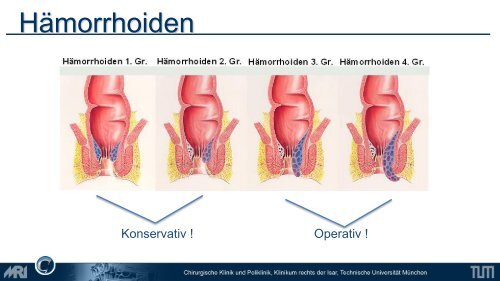 Lower GI - Chirurgie