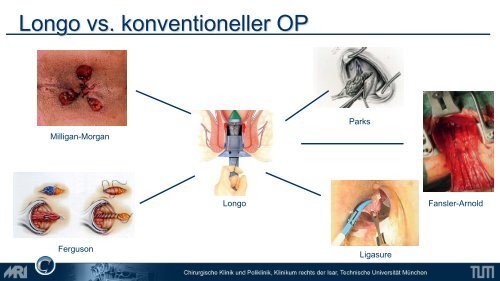 Lower GI - Chirurgie