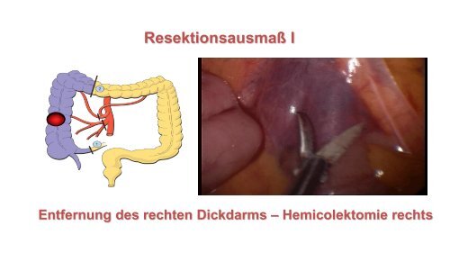 Lower GI - Chirurgie