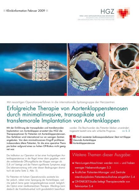 "Minimalinvasive Therapie von Aortenklappenstenosen" (PDF ... - Herz