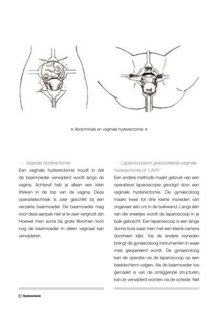 Hysterectomie (verwijderen van de baarmoeder)