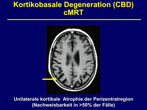 Alzheimer-Demenz