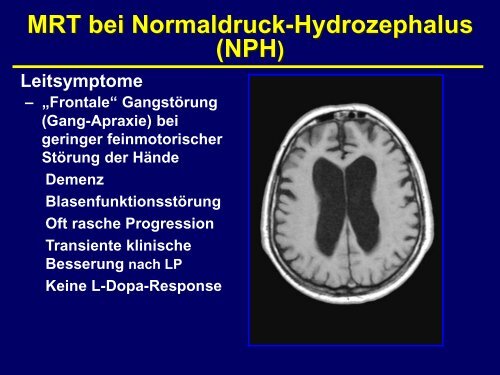 Alzheimer-Demenz