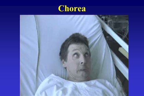 Chorea