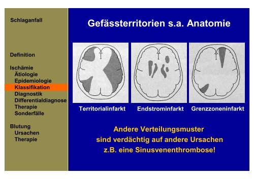 Schlaganfall der