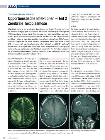 Opportunistische Infektionen â Teil 2 Zerebrale ... - HIV & More