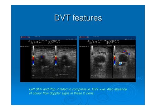 Ultrasound for DVT