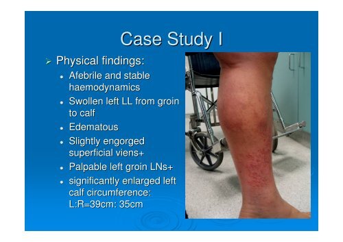 Ultrasound for DVT