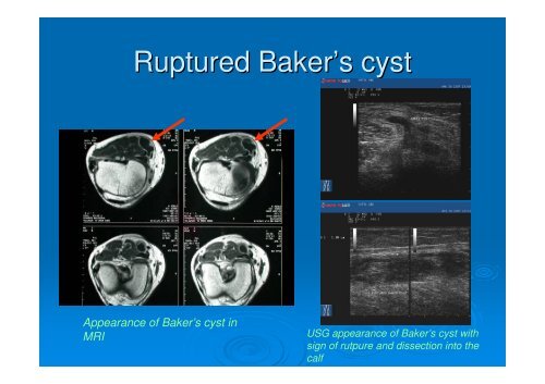 Ultrasound for DVT