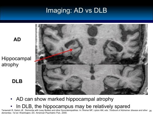 Differential Diagnosis of Dementias - Alzheimer's Association