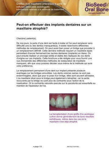 Peut-on effectuer des implants dentaires sur un maxillaire atrophié?