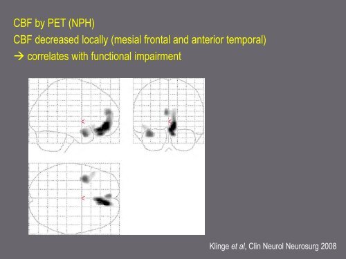 Mechanisms in hydrocephalus revealed by neuroimaging