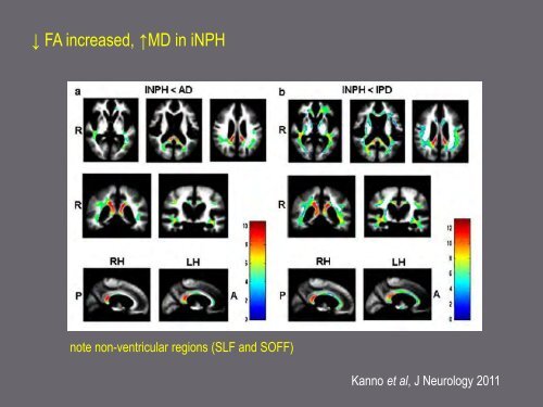 Mechanisms in hydrocephalus revealed by neuroimaging