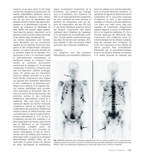 Le cancer, un fardeau mondial - IARC