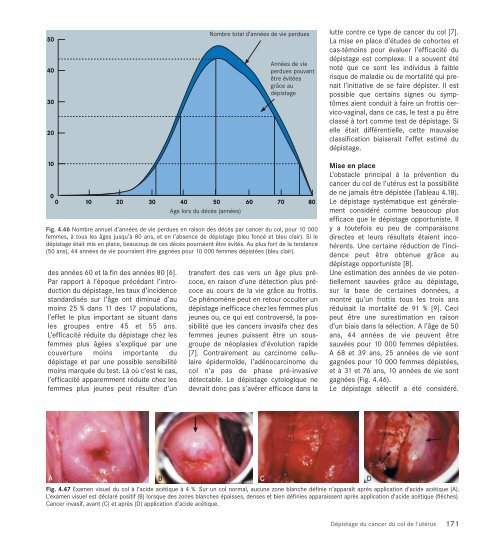 Le cancer, un fardeau mondial - IARC