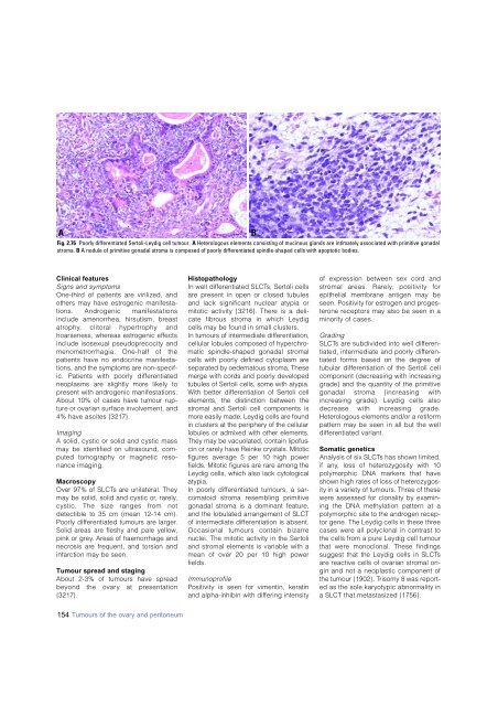 Invasive breast carcinoma - IARC