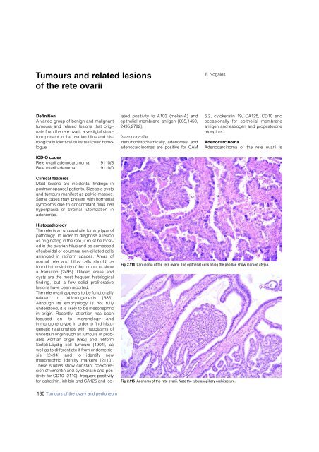 Invasive breast carcinoma - IARC