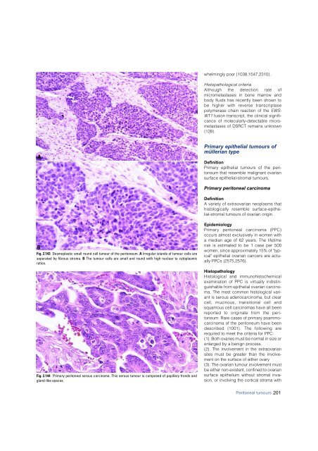 Invasive breast carcinoma - IARC