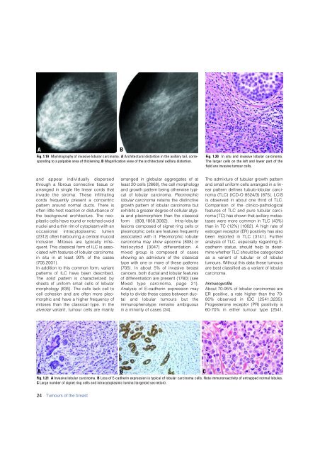 Invasive breast carcinoma - IARC