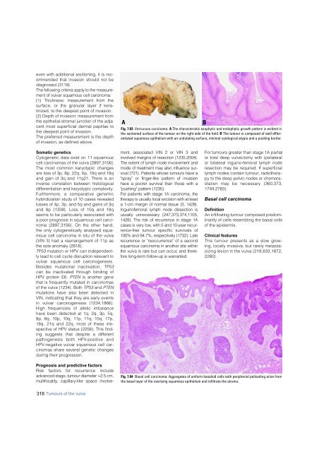 Invasive breast carcinoma - IARC