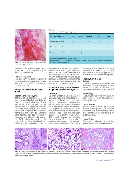 Invasive breast carcinoma - IARC