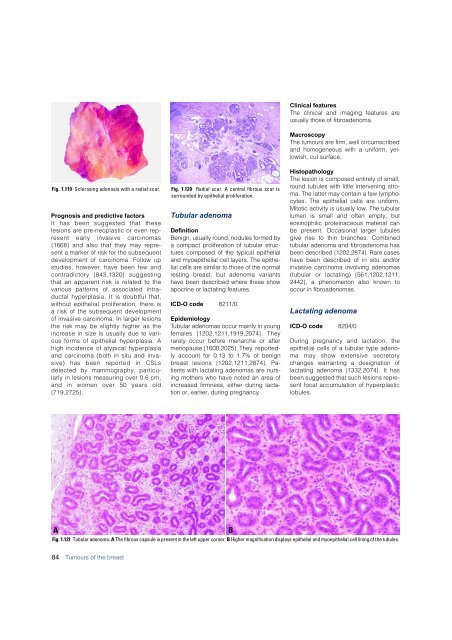 Invasive breast carcinoma - IARC