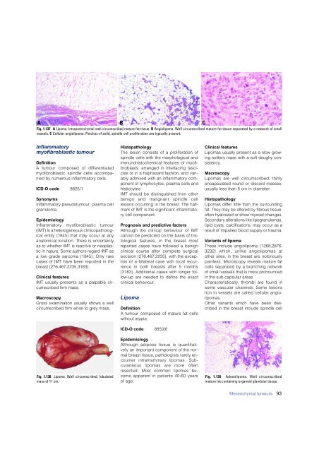 Invasive breast carcinoma - IARC