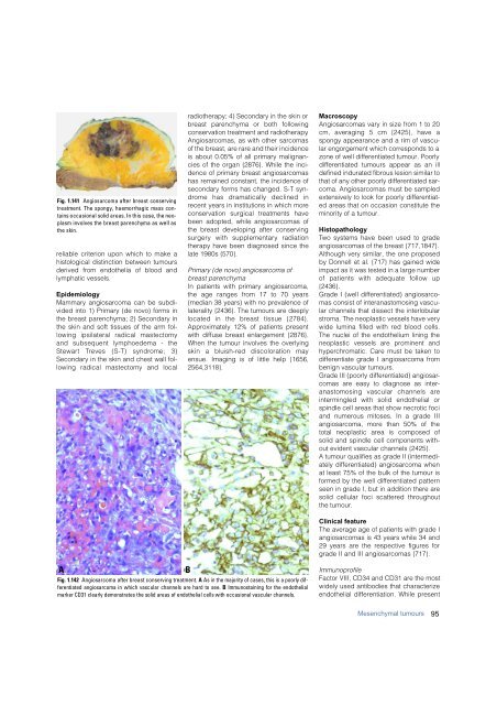 Invasive breast carcinoma - IARC