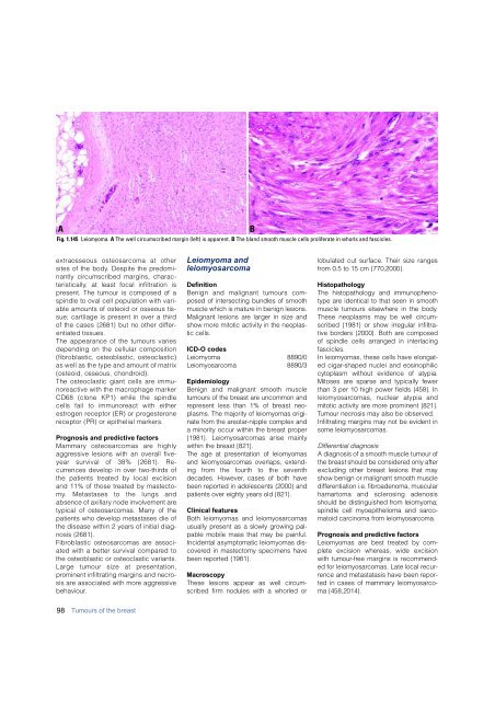 Invasive breast carcinoma - IARC