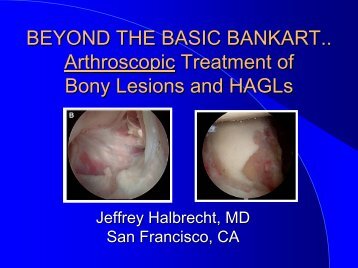 Beyond the Basic Bankart.. Arthroscopic Treatment of ... - IASM