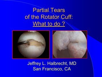 Partial Tears of the Rotator Cuff: What to do? - IASM